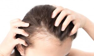 علل ریزش مو در خانم ها