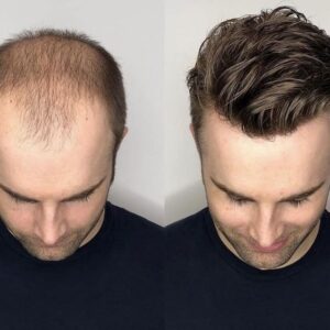 علت ریزش مو در آقایان چیست