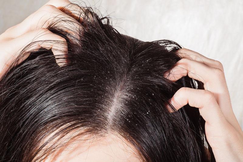 6 شامپو ضد شوره برای موهای چرب و ریزش مو