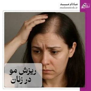 تصویر شاخص ریزش مو در زنان